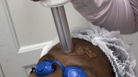 Laser e ondas de choque levam ácido hialurônico sem furo na pele
